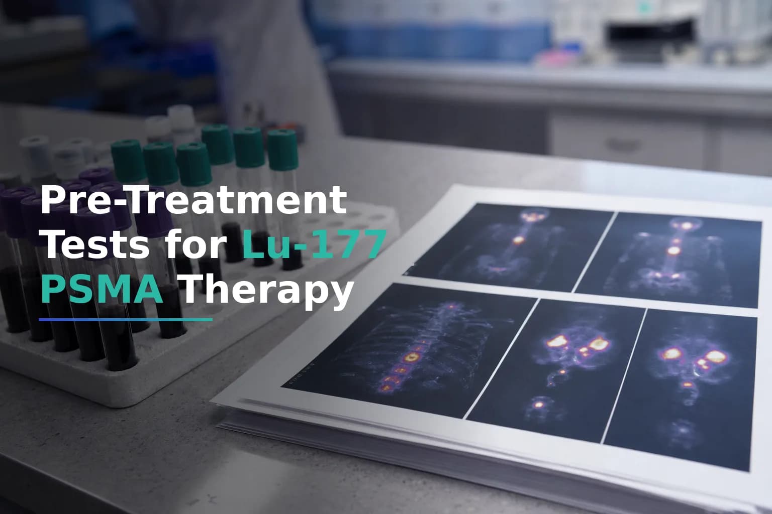 What Blood Tests and Scans Do You Need Before Lu-177 PSMA Treatment โ A Patient Guide to Pre-Therapy Eligibility Screening for Metastatic Prostate Cancer